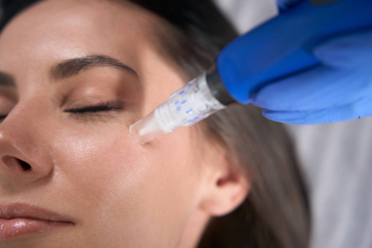 Featured image for 5 Things to Know Before Getting Microneedling