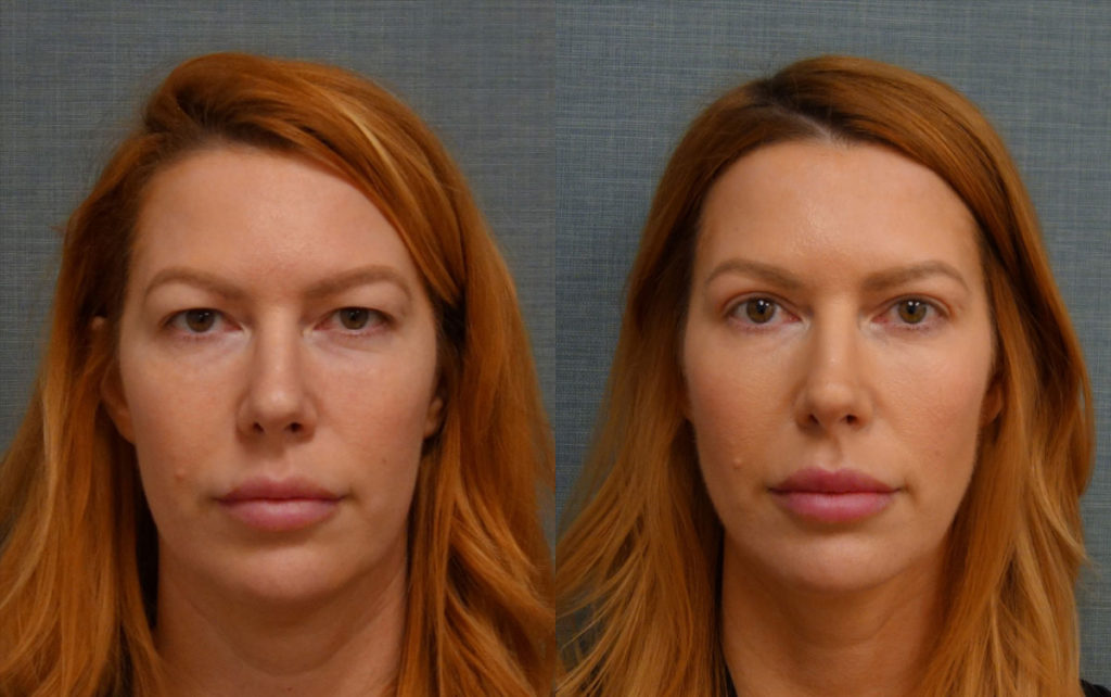 Bilateral Upper Eyelid Blepharoplasty, Chemical Peel to Lower Eyelids Patient 12-A 