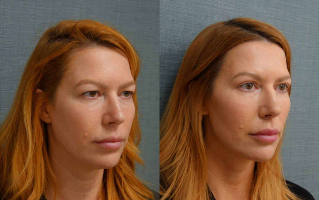 Bilateral Upper Eyelid Blepharoplasty, Chemical Peel to Lower Eyelids Patient 12-B 