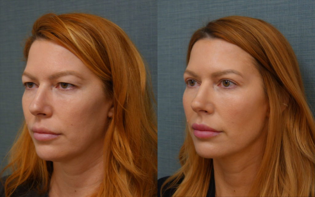 Bilateral Upper Eyelid Blepharoplasty, Chemical Peel to Lower Eyelids Patient 12-C 