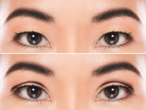 Featured image for The Differences Between Incisional and Non-Incisional Double Eyelid Surgery