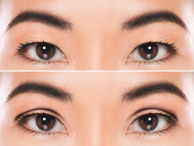 Featured image for The Differences Between Incisional and Non-Incisional Double Eyelid Surgery