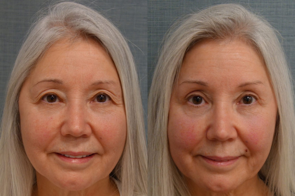 Bilateral Upper Eyelid Blepharoplasty, Mini Brow Lift Patient 25-A 