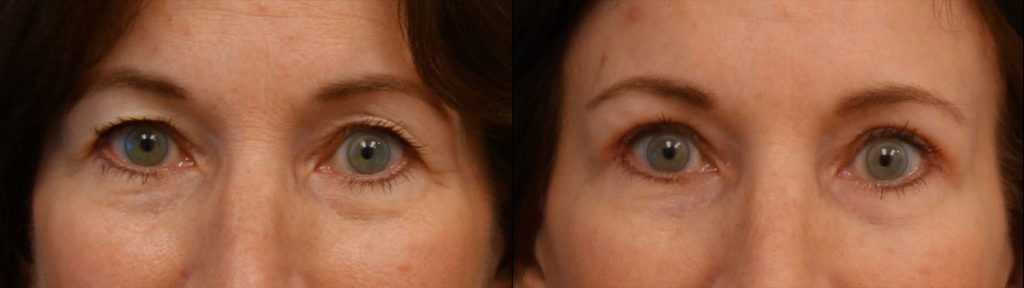 Upper Eyelid Blepharoplasty, Mini Brow Lift Patient 10-A 