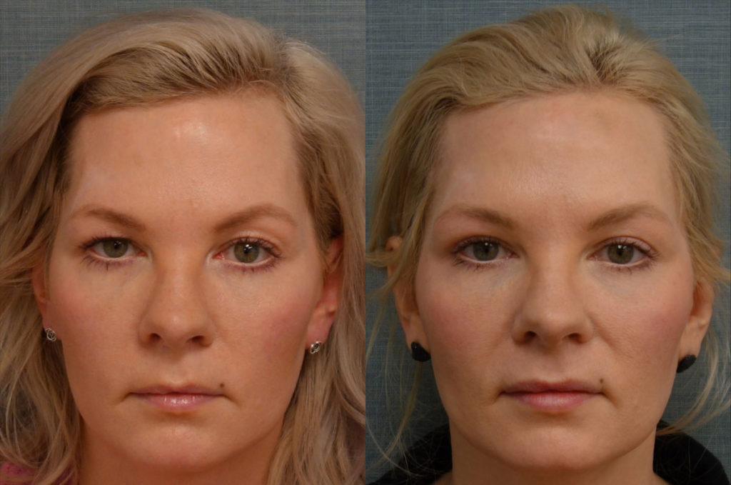 Upper Blepharoplasty, Right Upper Eyelid Internal Ptosis Repair, Right Mini Brow Lift Patient 26-A 