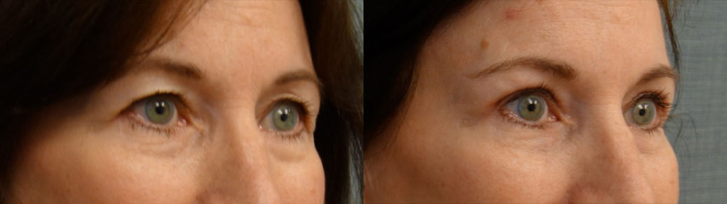 Upper Eyelid Blepharoplasty, Mini Brow Lift Patient 10-B 