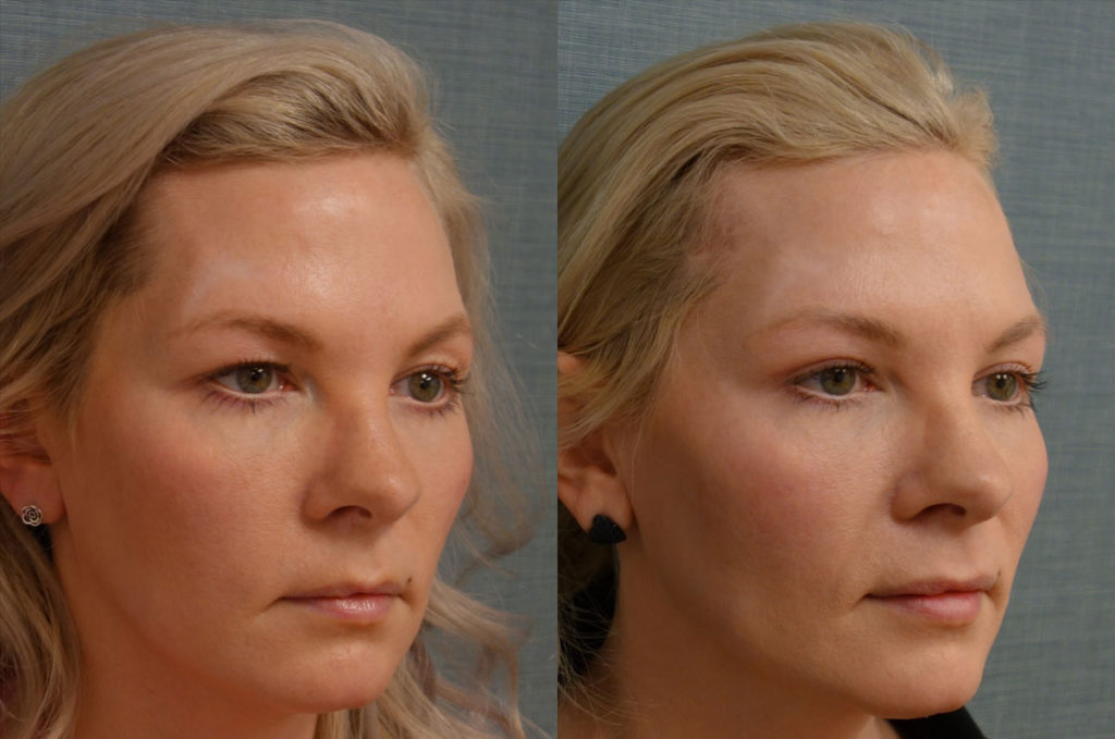 Upper Blepharoplasty, Right Upper Eyelid Internal Ptosis Repair, Right Mini Brow Lift Patient 26-B 