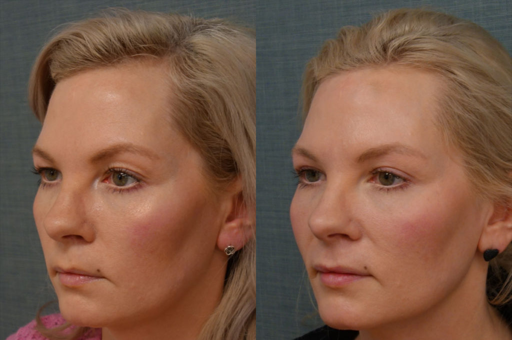 Upper Blepharoplasty, Right Upper Eyelid Internal Ptosis Repair, Right Mini Brow Lift Patient 26-C 