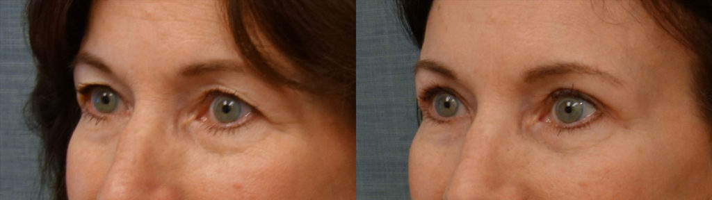 Upper Eyelid Blepharoplasty, Mini Brow Lift Patient 10-C 