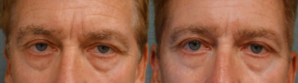 Bilateral Upper Eyelid Blepharoplasty, Bilateral Upper Eyelid Internal Ptosis Repair Patient 19-A 