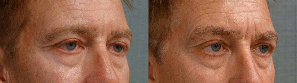 Bilateral Upper Eyelid Blepharoplasty, Bilateral Upper Eyelid Internal Ptosis Repair Patient 19-B 