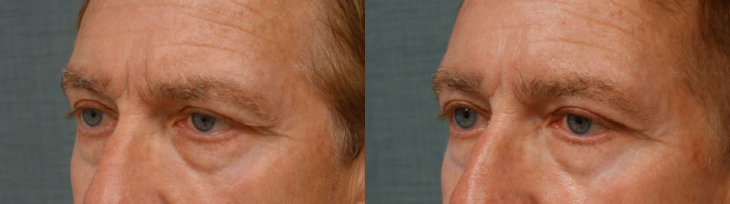 Bilateral Upper Eyelid Blepharoplasty, Bilateral Upper Eyelid Internal Ptosis Repair Patient 19-C 