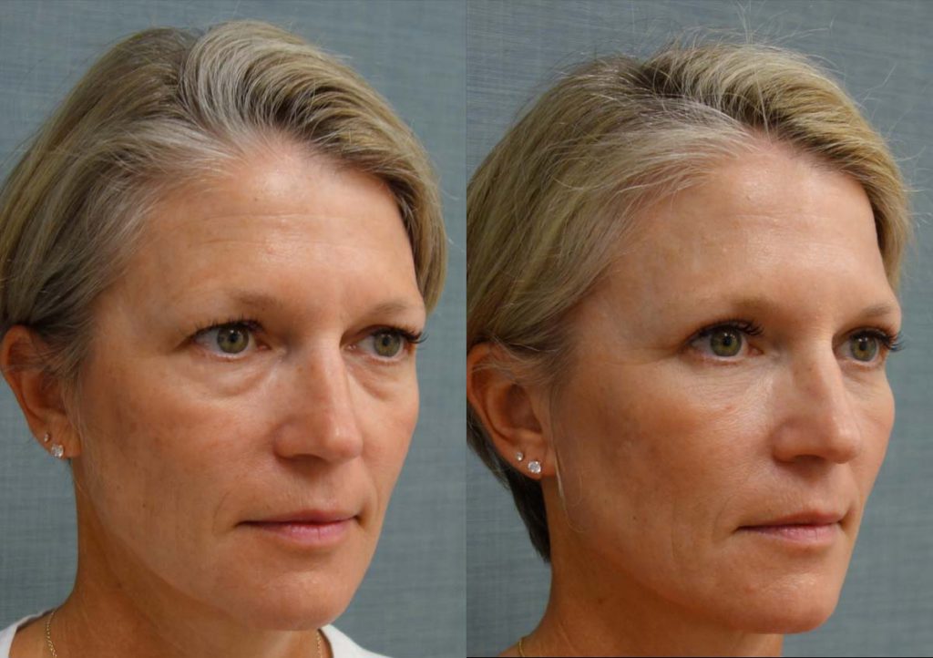 Upper and Lower Eyelid Blepharoplasty with Internal Cheek Elevation, Eyelid Laser Resurfacing Patient 25-B 