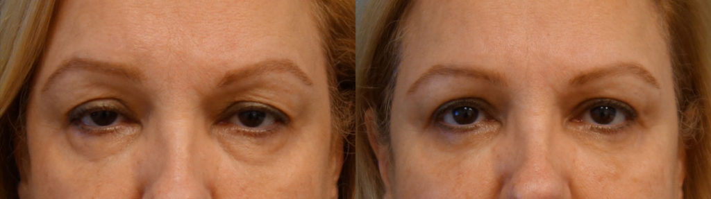 Bilateral Upper Eyelid Blepharoplasty, Bilateral Upper Eyelid Internal Ptosis Repair, Bilateral Lower Eyelid Blepharoplasty Patient 60-A 