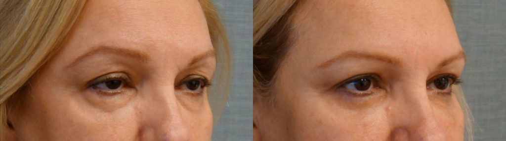 Bilateral Upper Eyelid Blepharoplasty, Bilateral Upper Eyelid Internal Ptosis Repair, Bilateral Lower Eyelid Blepharoplasty Patient 41-B 