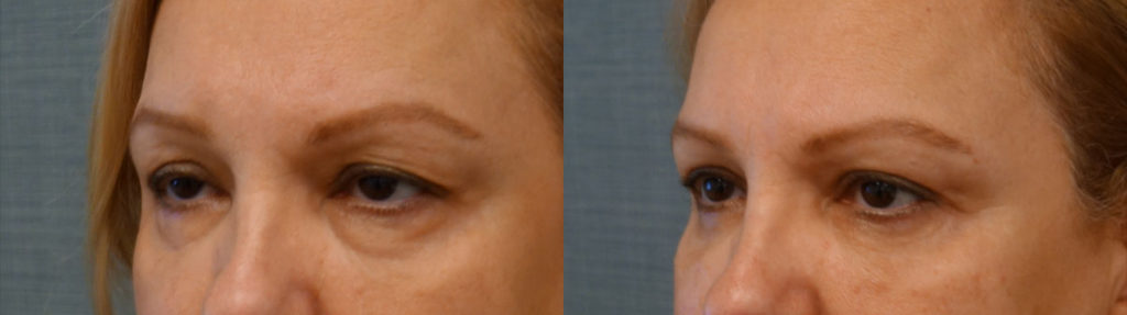 Bilateral Upper Eyelid Blepharoplasty, Bilateral Upper Eyelid Internal Ptosis Repair, Bilateral Lower Eyelid Blepharoplasty Patient 60-C 