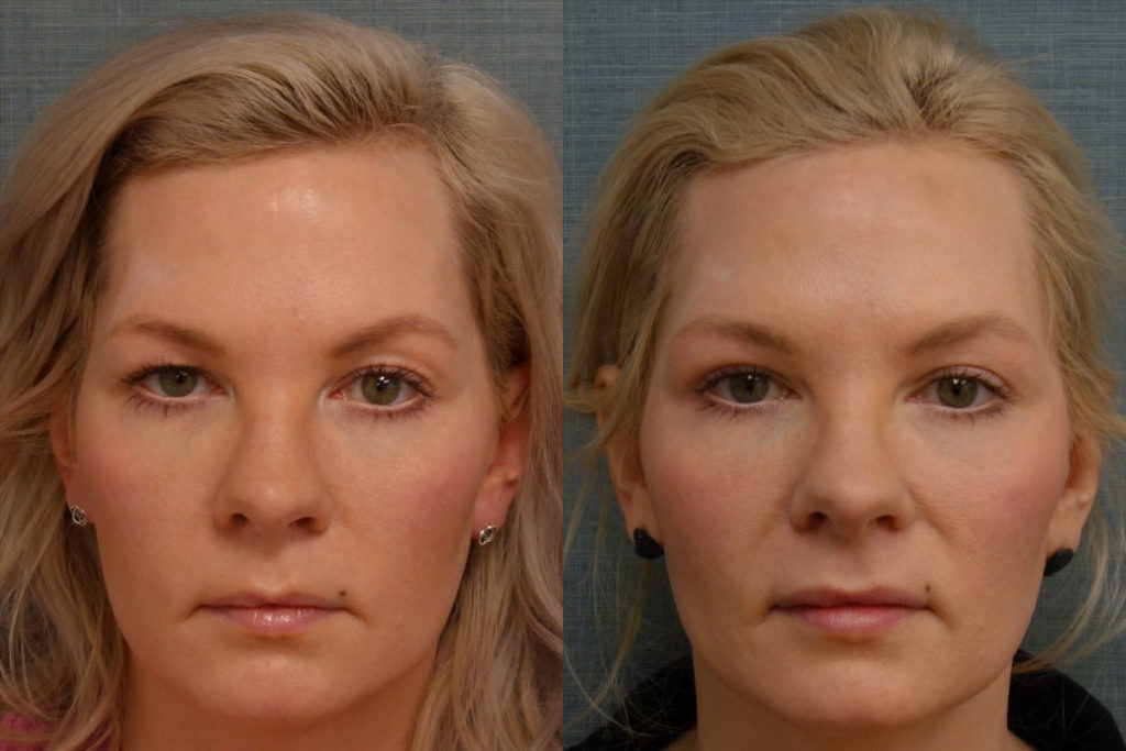 Bilateral Upper Eyelid Blepharoplasty, Right Upper Eyelid Internal Ptosis Repair, Right Mini Brow Lift Patient 10-A 