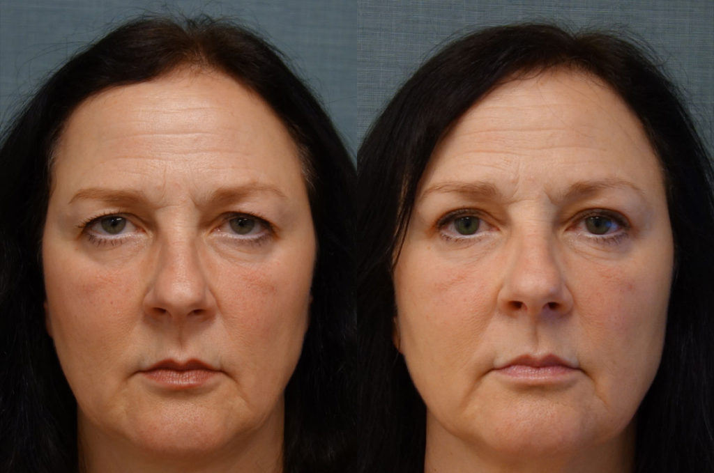 Upper Eyelid Blepharoplasty, Mini Brow Lift, Bilateral Internal Ptosis Repair Patient 25-A 