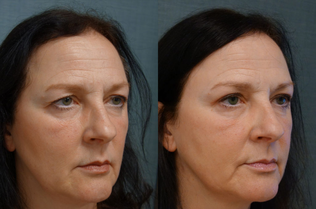 Upper Eyelid Blepharoplasty, Mini Brow Lift, Bilateral Internal Ptosis Repair Patient 25-B 