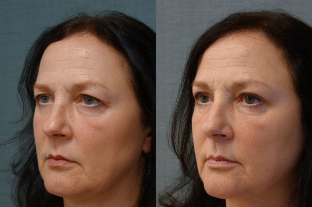 Upper Eyelid Blepharoplasty, Mini Brow Lift, Bilateral Internal Ptosis Repair Patient 25-C 