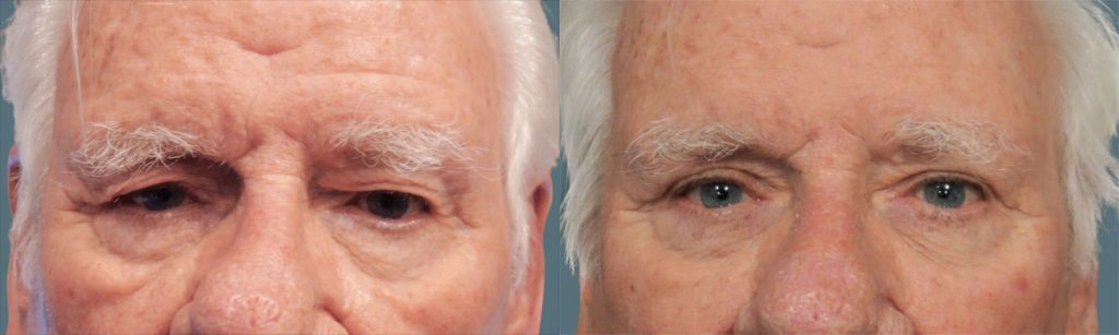 Upper Eyelid Blepharoplasty Patient 41-C 