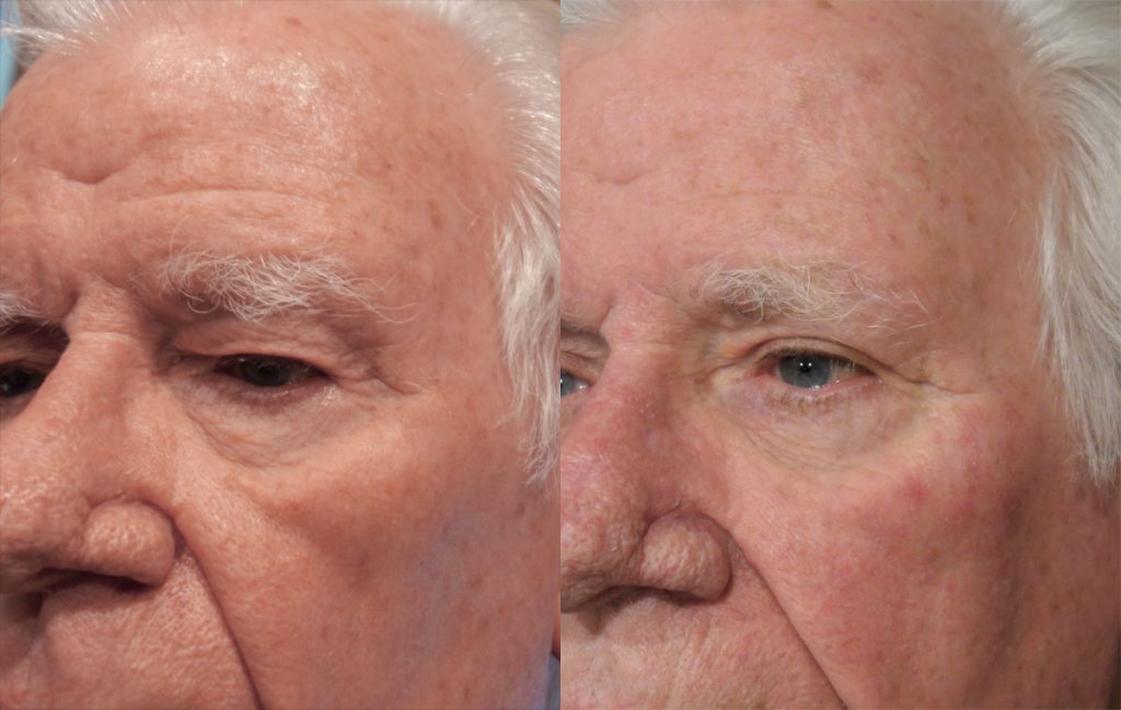 Upper Eyelid Blepharoplasty Patient 41-B 