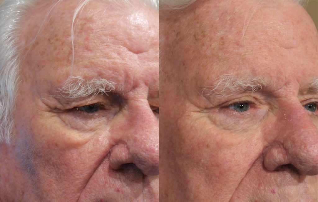 Upper Eyelid Blepharoplasty Patient 41-A 