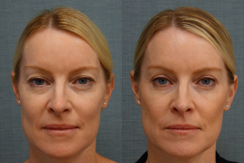 Bilateral Upper Eyelid Blepharoplasty, Right Upper Eyelid Internal Ptosis Repair Patient 17-A 