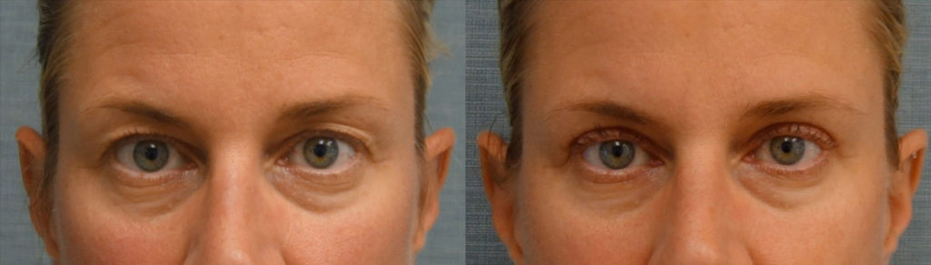 Bilateral Upper Eyelid Blepharoplasty Patient 52-A 