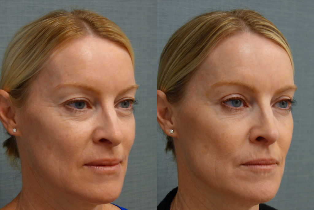 Bilateral Upper Eyelid Blepharoplasty, Right Upper Eyelid Internal Ptosis Repair Patient 17-B 