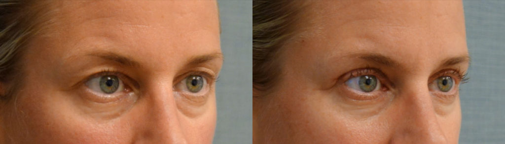 Bilateral Upper Eyelid Blepharoplasty Patient 52-B 