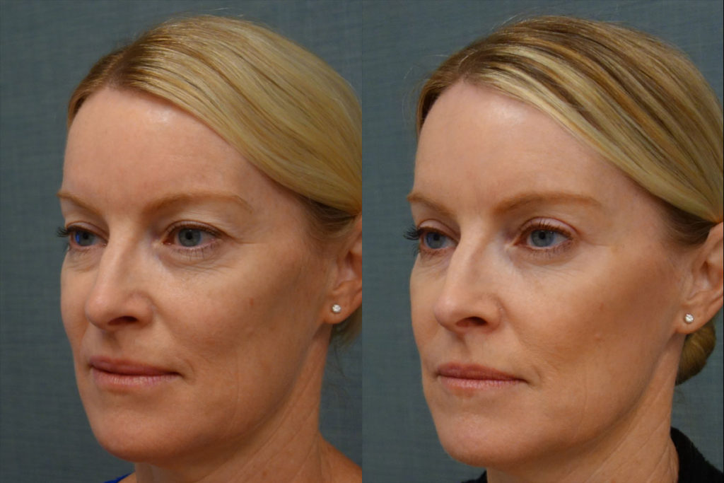 Bilateral Upper Eyelid Blepharoplasty, Right Upper Eyelid Internal Ptosis Repair Patient 17-C 