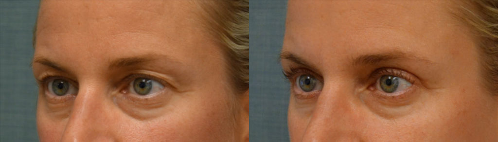 Bilateral Upper Eyelid Blepharoplasty Patient 52-C 