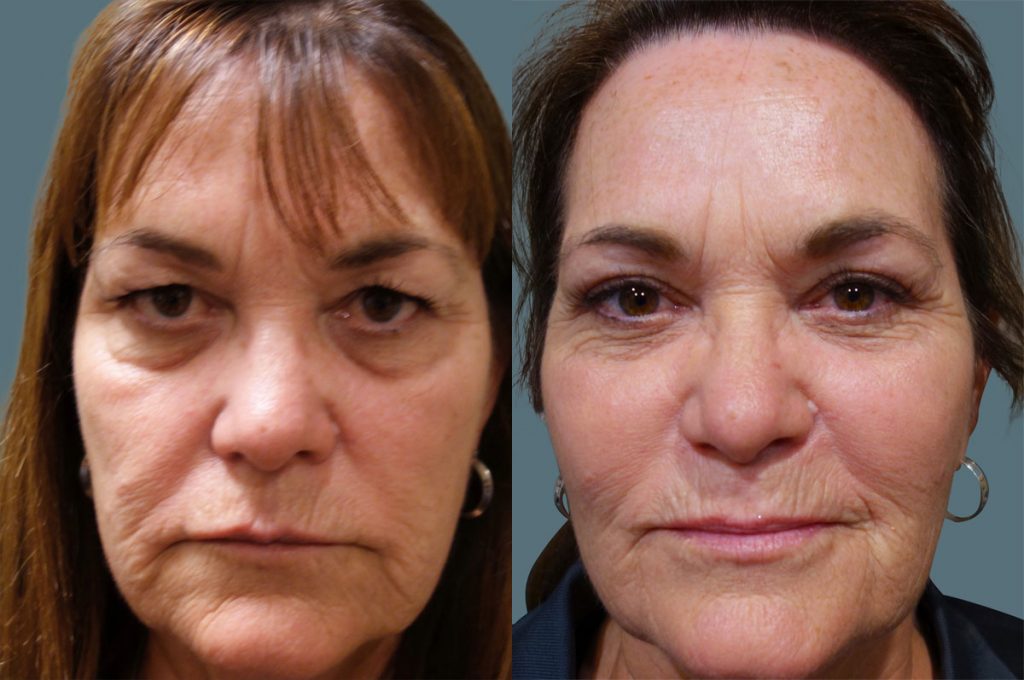 Upper Eyelid Blepharoplasty Patient 42-C 