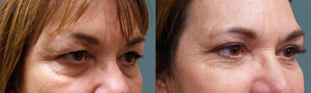 Upper Eyelid Blepharoplasty Patient 42-A 