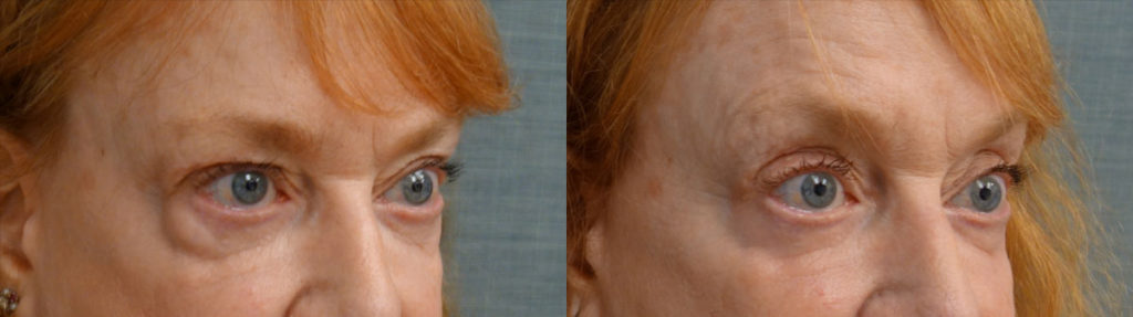 Bilateral Lower Eyelid Blepharoplasty, Chemical Peel to Bilateral Lower Eyelids, Left Lower Eyelid Lesion Excision Patient 39-B 