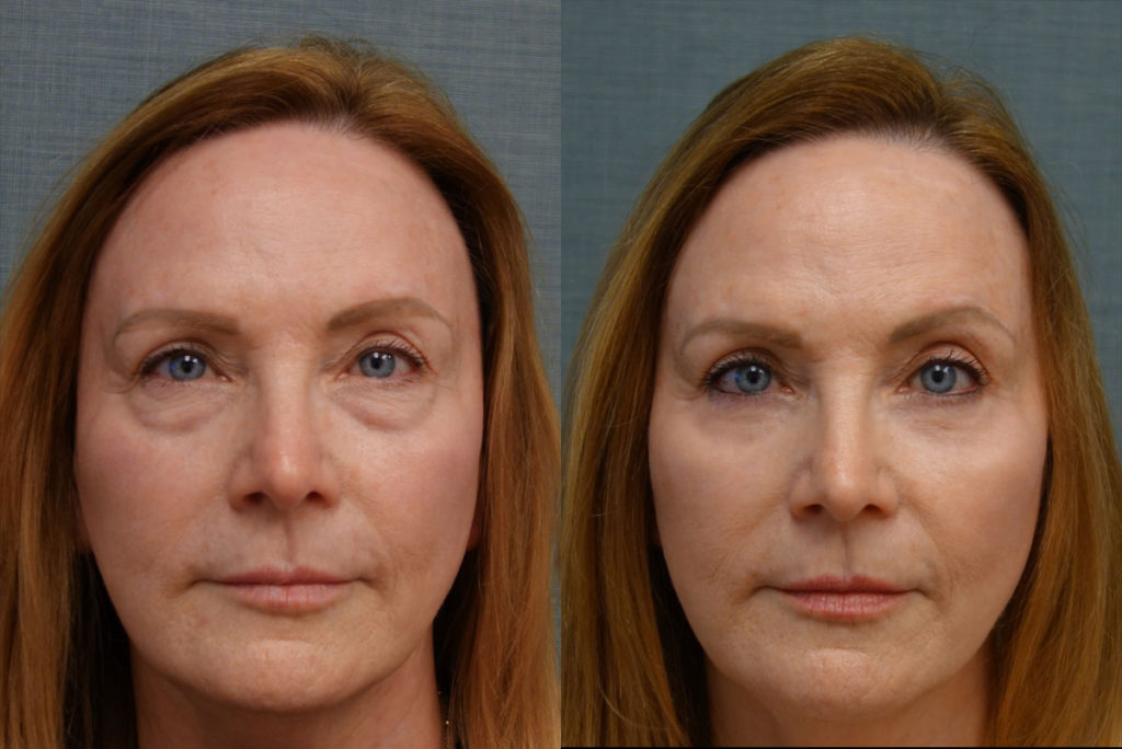 Bilateral Lower Eyelid Blepharoplasty, Chemical Peel to Lower Eyelids Patient 40-A 