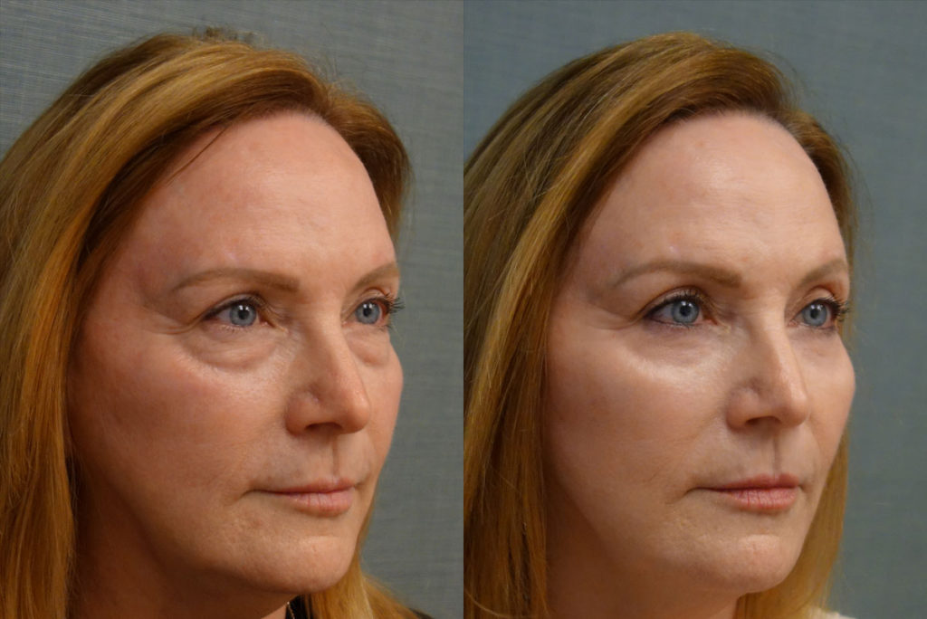 Bilateral Lower Eyelid Blepharoplasty, Chemical Peel to Lower Eyelids Patient 40-B 