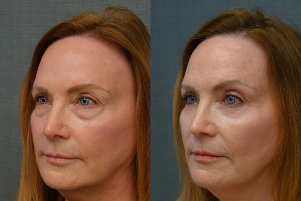 Bilateral Lower Eyelid Blepharoplasty, Chemical Peel to Lower Eyelids Patient 40-C 