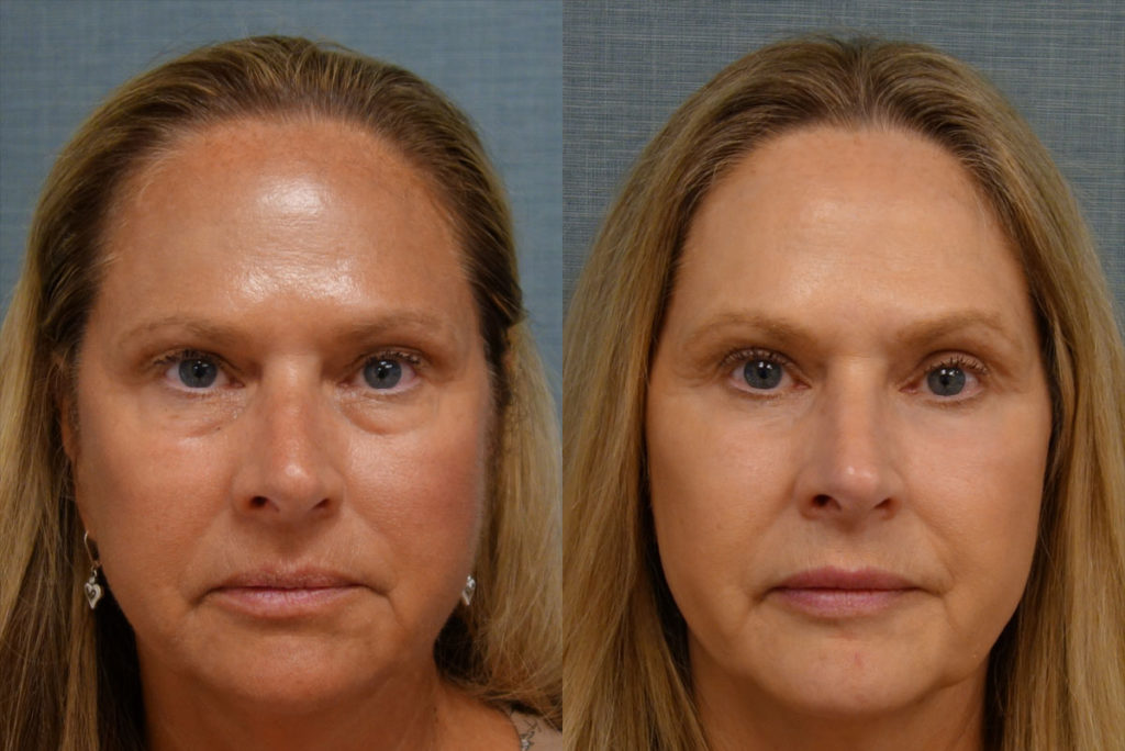 Bilateral Upper Eyelid Blepharoplasty, Bilateral Lower Eyelid Blepharoplasty, Morpheus RF Microneedling to Mid-Face, Chemical Peel to Bilateral Lower Eyelids Patient 57-A 