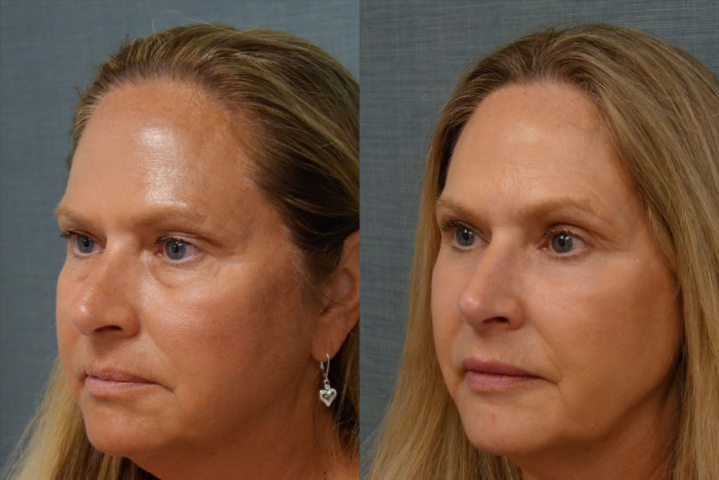 Bilateral Upper Eyelid Blepharoplasty, Bilateral Lower Eyelid Blepharoplasty, Morpheus RF Microneedling to Mid-Face, Chemical Peel to Bilateral Lower Eyelids Patient 57-C 