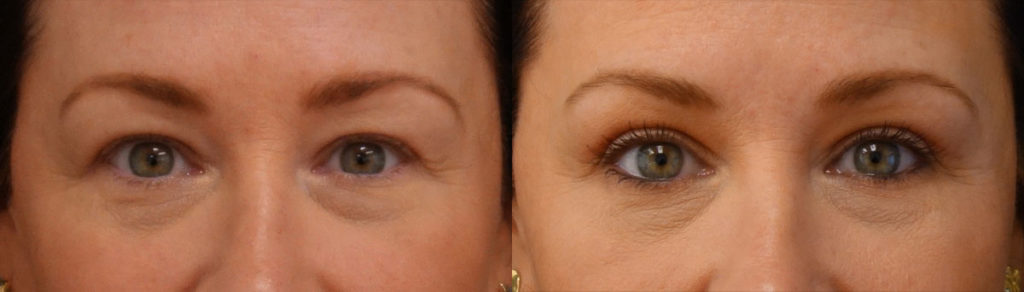 Bilateral Upper Eyelid Blepharoplasty Patient 53-A 