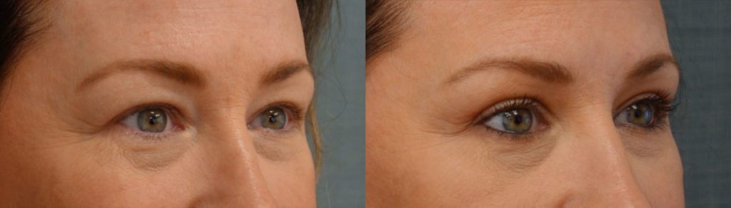 Bilateral Upper Eyelid Blepharoplasty Patient 53-B 