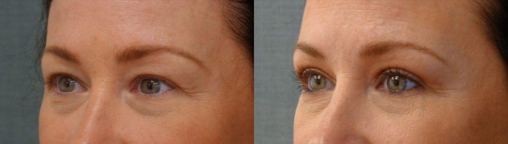 Bilateral Upper Eyelid Blepharoplasty Patient 53-C 