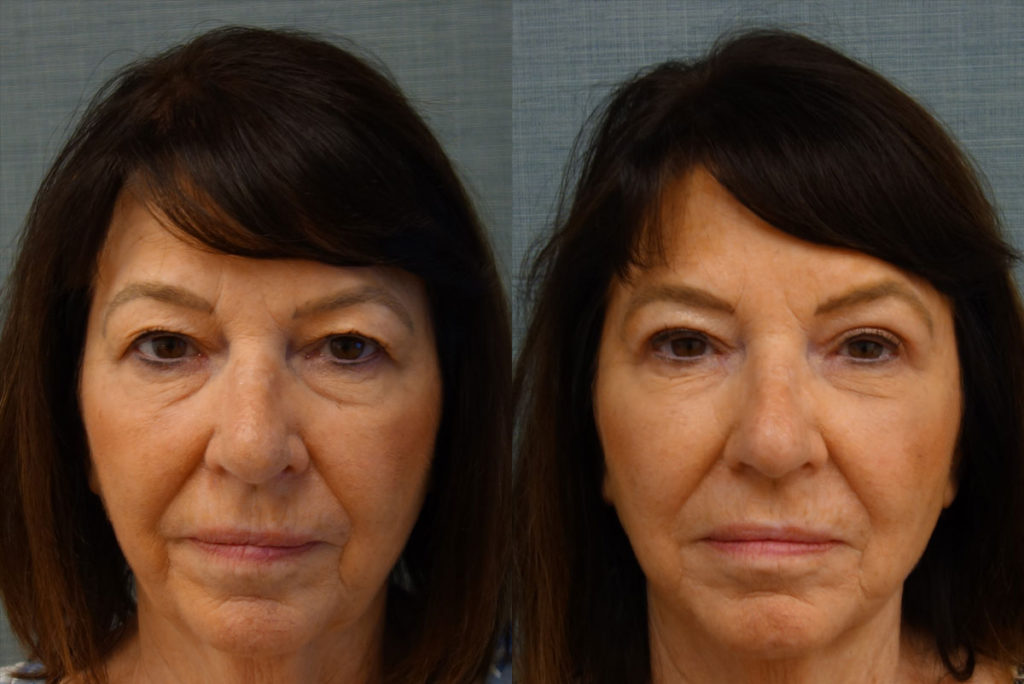 Bilateral Upper Eyelid Blepharoplasty Patient 56-A 