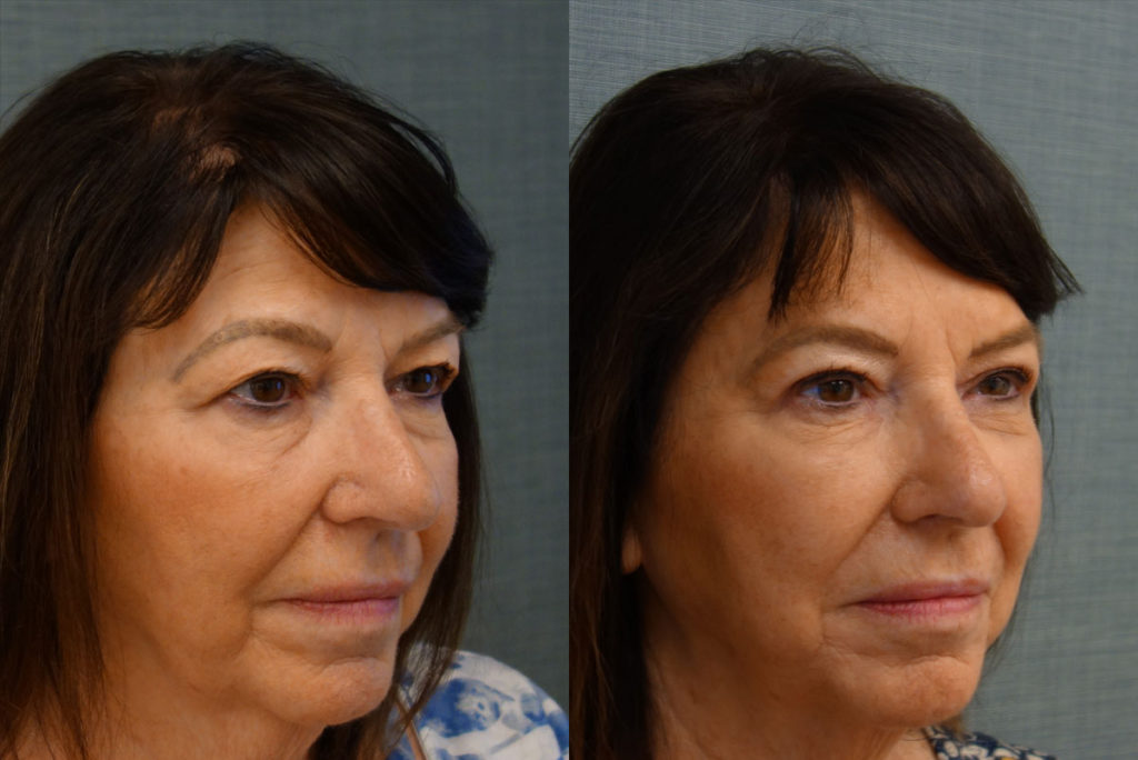 Bilateral Upper Eyelid Blepharoplasty Patient 56-B 