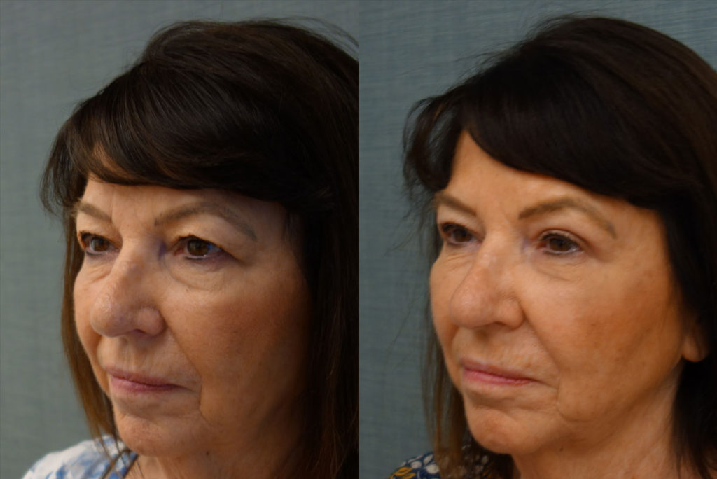 Bilateral Upper Eyelid Blepharoplasty Patient 56-C 