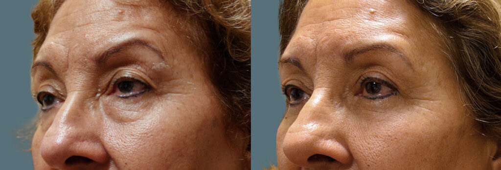 Lower Eyelid Blepharoplasty and Upper Eyelid Ptosis Repair Patient 27-B 