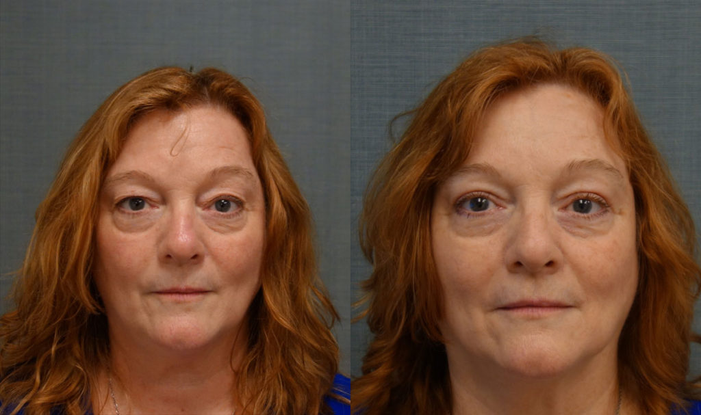 Bilateral Upper Eyelid Blepharoplasty Patient 57-A 