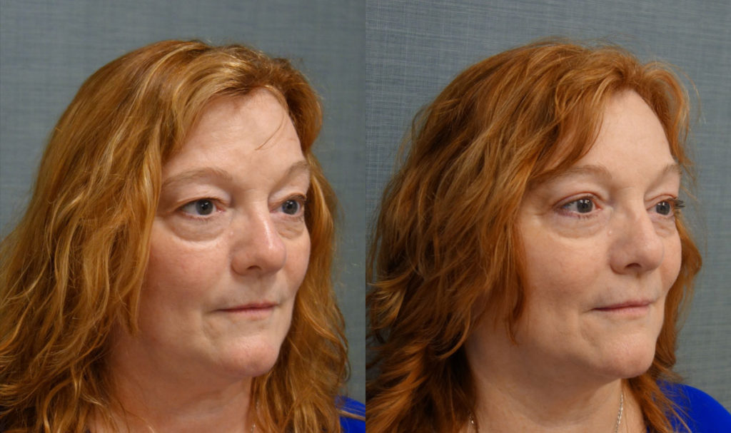 Bilateral Upper Eyelid Blepharoplasty Patient 57-B 